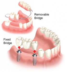 Chi phí cho trồng răng sứ theo kỹ thuật Implant