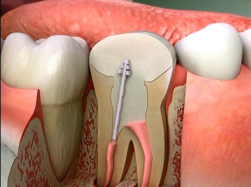 Quy trình thực hiện lấy tủy răng khi phục hình răng sứ