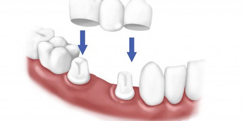 Phương pháp chụp răng sứ hiện nay