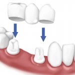 bọc mão răng sứ