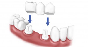 bọc mão răng sứ