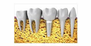 kỹ thuật trồng răng implant