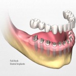 trồng răng implant uy tín