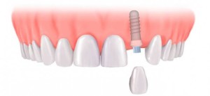 Cấy ghép implant cho một răng