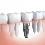 Cấy ghép implant là gì? Có hiệu quả không?