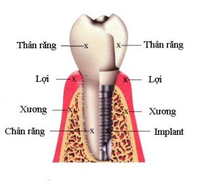 Cấy ghép răng implant tại TP Hồ Chí Minh