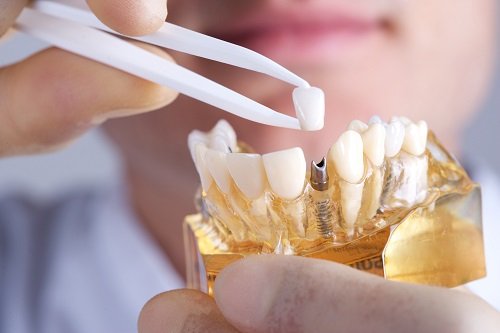 Phản hồi của khách hàng về cấy ghép Implant 1