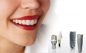 trường hợp không nên implant