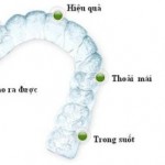 Giá niềng răng không mắc cài Clear Aligner bao nhiêu?