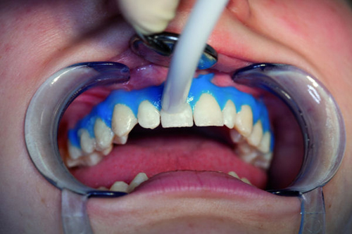 Kết quả hình ảnh cho quy trình tẩy trắng răng