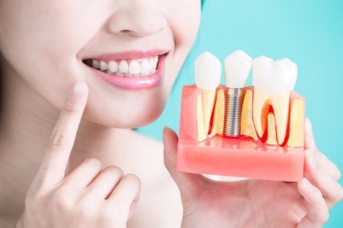 Ai được cấy ghép Implant? 2