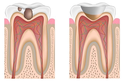 Vì sao phải điều trị tủy răng? 1