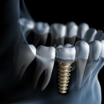 Chi phí cấy ghép răng implant giá bao nhiêu?