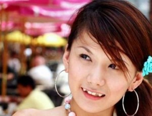 Ưu điểm của giải pháp niềng răng khểnh