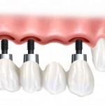 Đặc điểm của công nghệ cấy ghép Implant 4S