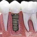 Chi phí cấy ghép răng implant bao nhiêu tiền