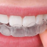 Niềng răng không mắc cài invisalign giá bao nhiêu?