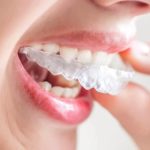 Chi phí niềng răng Invisalign