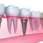 Trung tâm cấy ghép Implant uy tín tại TPHCM?