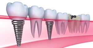 Cấy ghép implant ở TP HCM