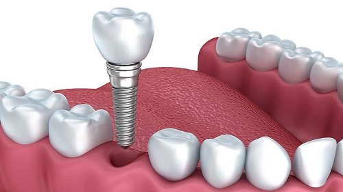 Cấy ghép răng implant ở đâu? 2