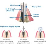 Cấy ghép implant ở đâu tốt và uy tín