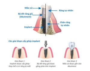 Cấy ghép implant ở đâu tốt và uy tín