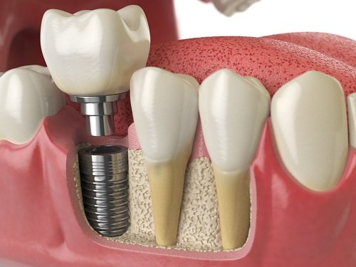 Đặc điểm của công nghệ cấy ghép Implant 4S 3