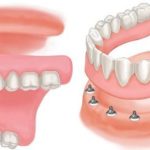 Chăm sóc khi cấy ghép implant