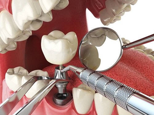 Cấy ghép răng implant tại TP Hồ Chí Minh 3