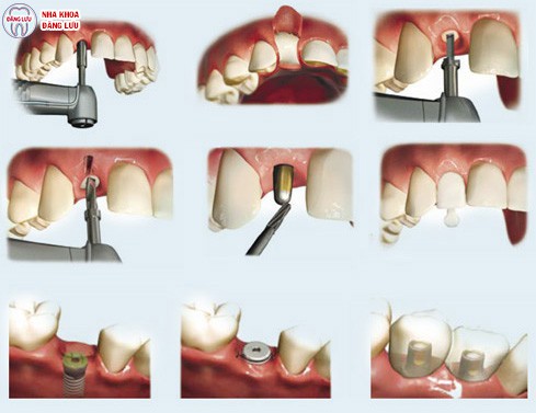 Cấy ghép răng implant có mức giá bao nhiêu