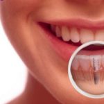 Chi phí trồng răng implant bao nhiêu?