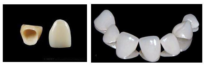 bọc răng sứ veneer