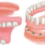 Implant tháo lắp cho người mất toàn hàm