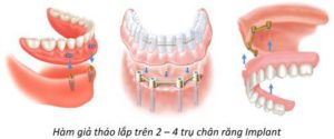 Implant tháo lắp cho người mất toàn hàm