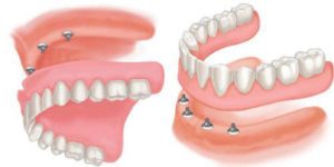 Implant tháo lắp cho người mất toàn hàm