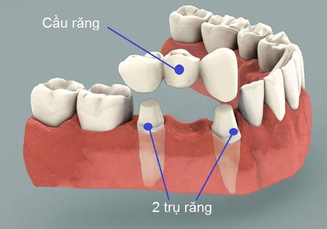 Những cách phục hình răng thẩm mỹ