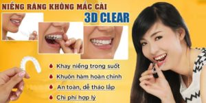 Niềng răng không mắc cài 3D Clear