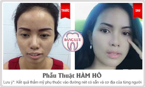 phẫu thuật hàm hô móm an toàn và hiệu quả