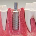 Trồng răng Implant