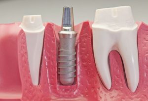 Trồng răng Implant