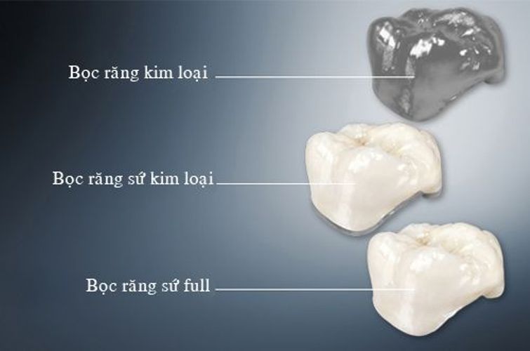 Các loại răng sứ