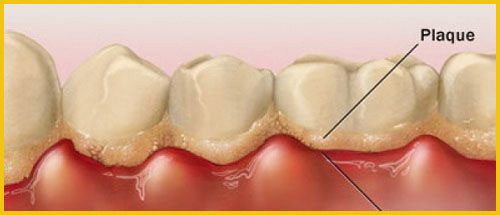 cạo vôi răng có làm trắng răng không