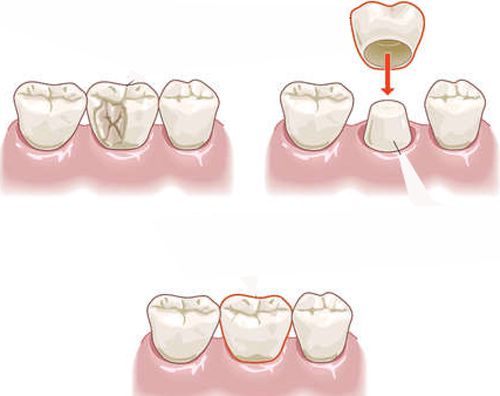 răng đã lấy tủy có nên bọc sứ lại không