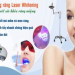 Tẩy trắng răng bằng laser bao nhiêu tiền