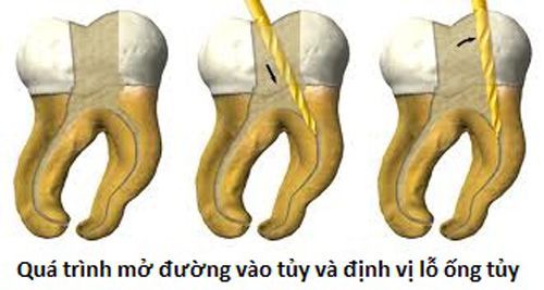 bọc răng sứ có phải lấy tủy khôngbọc răng sứ có phải lấy tủy không