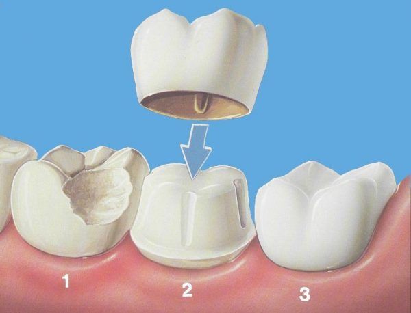 bọc răng sứ loại nào tốt