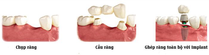 trồng răng sứ giá bao nhiêu