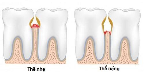 Chảy máu chân răng là bệnh gì? 1