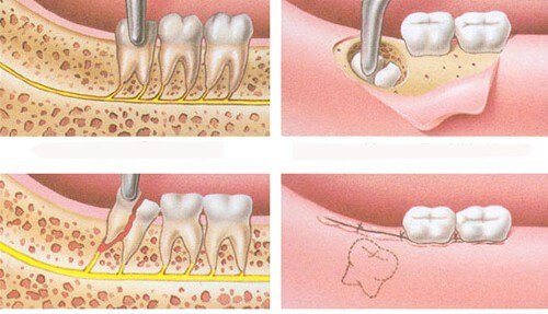 Dấu hiệu mọc răng khôn bạn nên biết 3